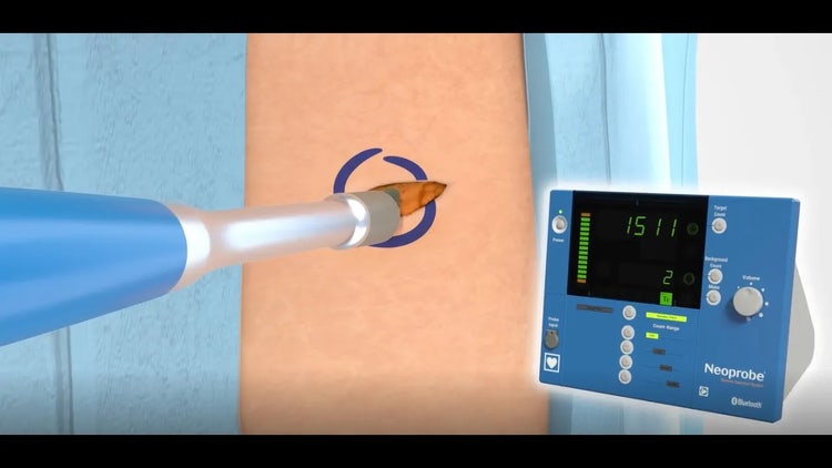 Watch the Neoprobe GDS for Melanoma Procedure Animation
